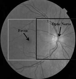 眼底图像示例,Fovea表示黄斑中央凹,Optic Nerve 表示视觉神经头